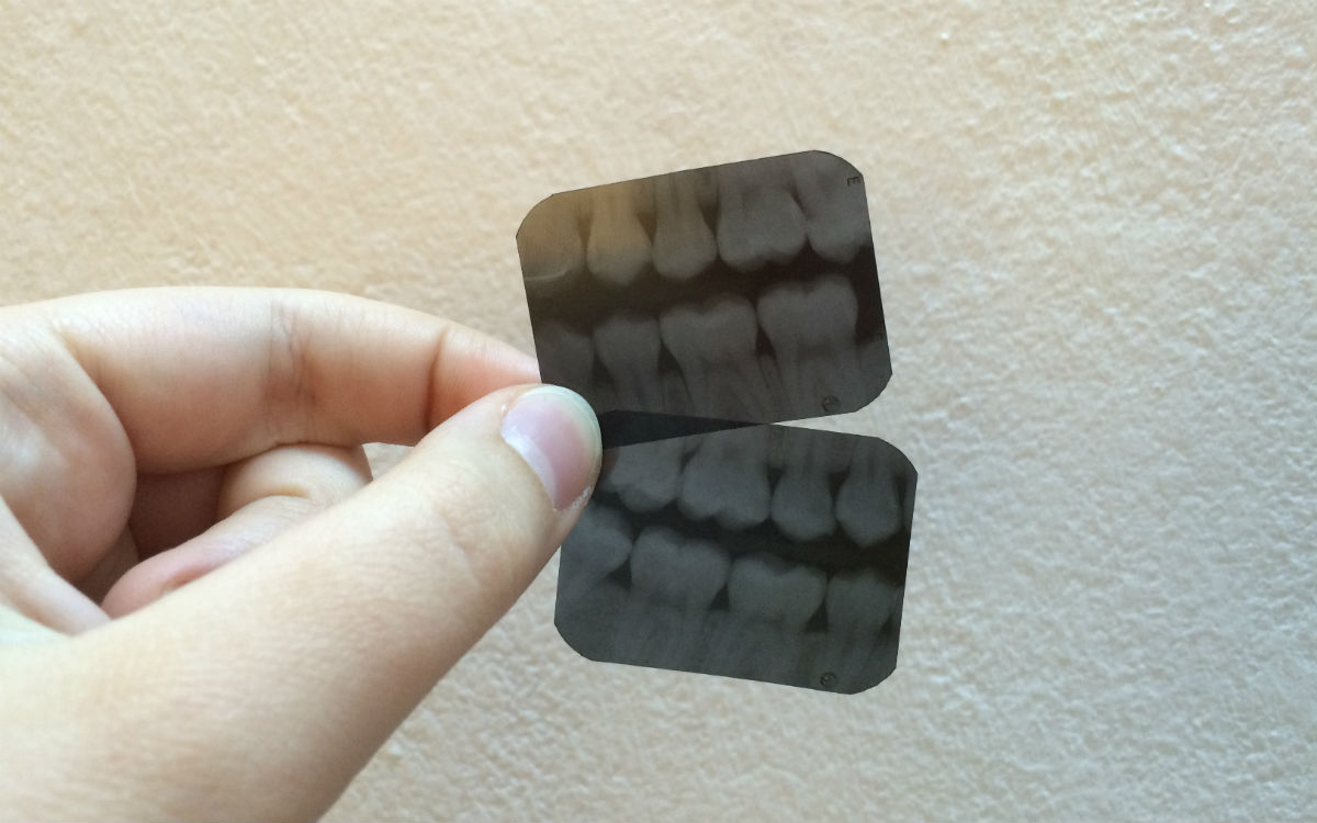 2x3cm-große Röntgenaufnahmen meiner Backenzähne aus dem Zentrum für Zahnmedizinstudenten in Irbid. (Foto: EMS/Schiller)